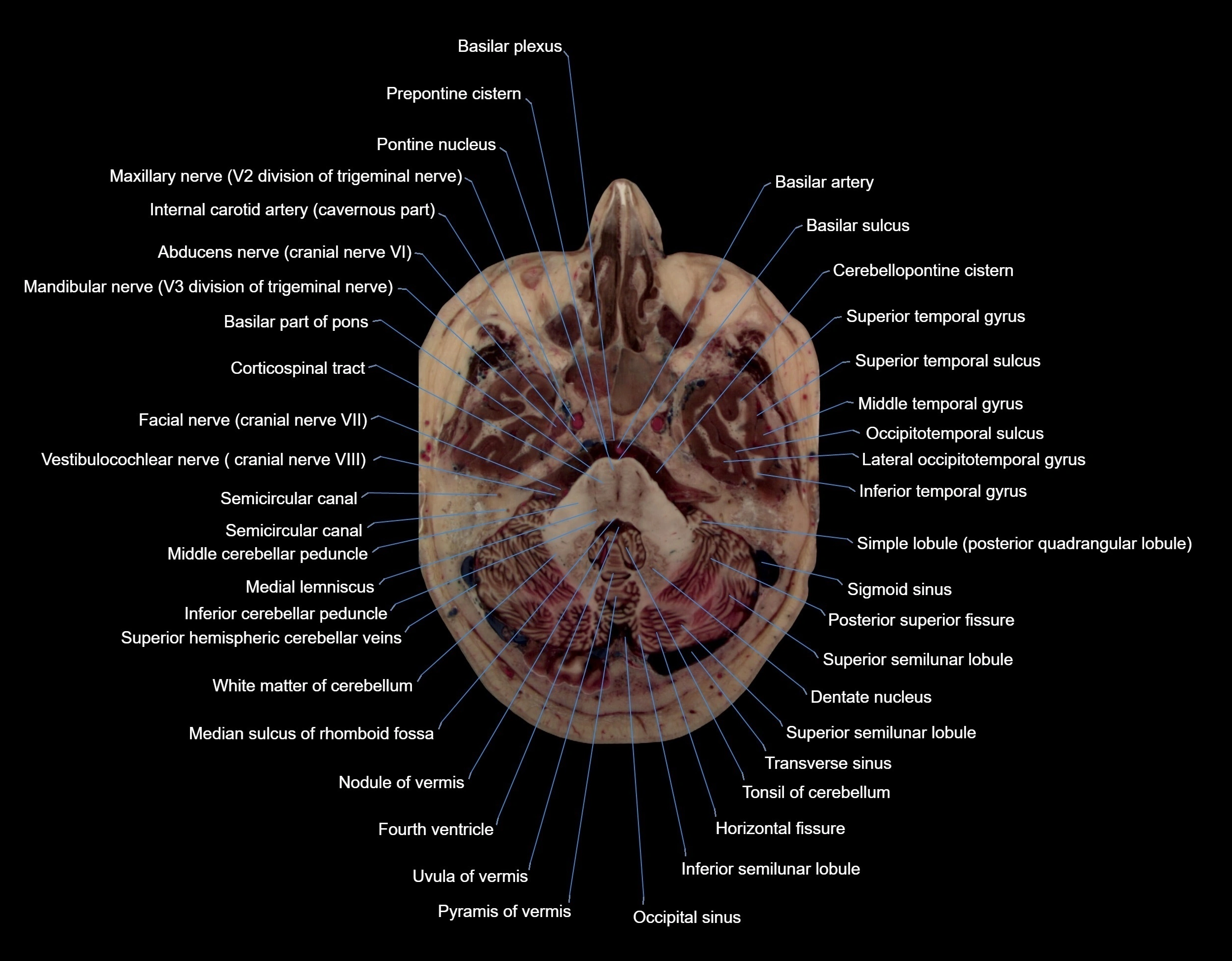 MRI Brain axial cross sectional radiology anatomy 3T image  -img-000020.webp